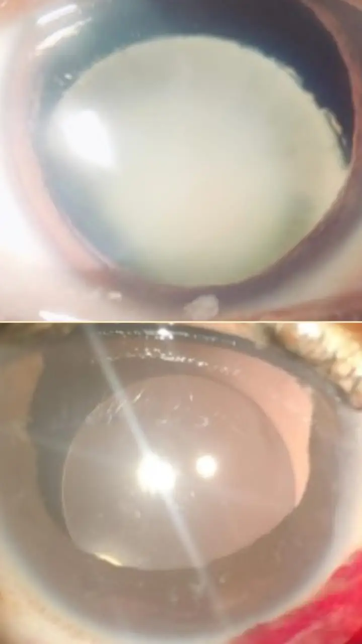 cataract2.webp